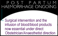 Post Partum Haemorrhage Ongoing